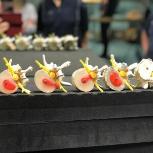 Smisek Bandscheibenmodell - Stadien Bandscheibenvorfall