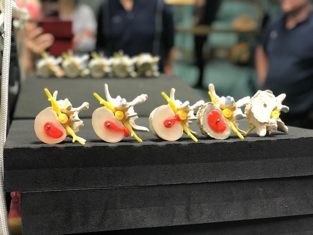 Smisek Bandscheibenmodell - Stadien Bandscheibenvorfall